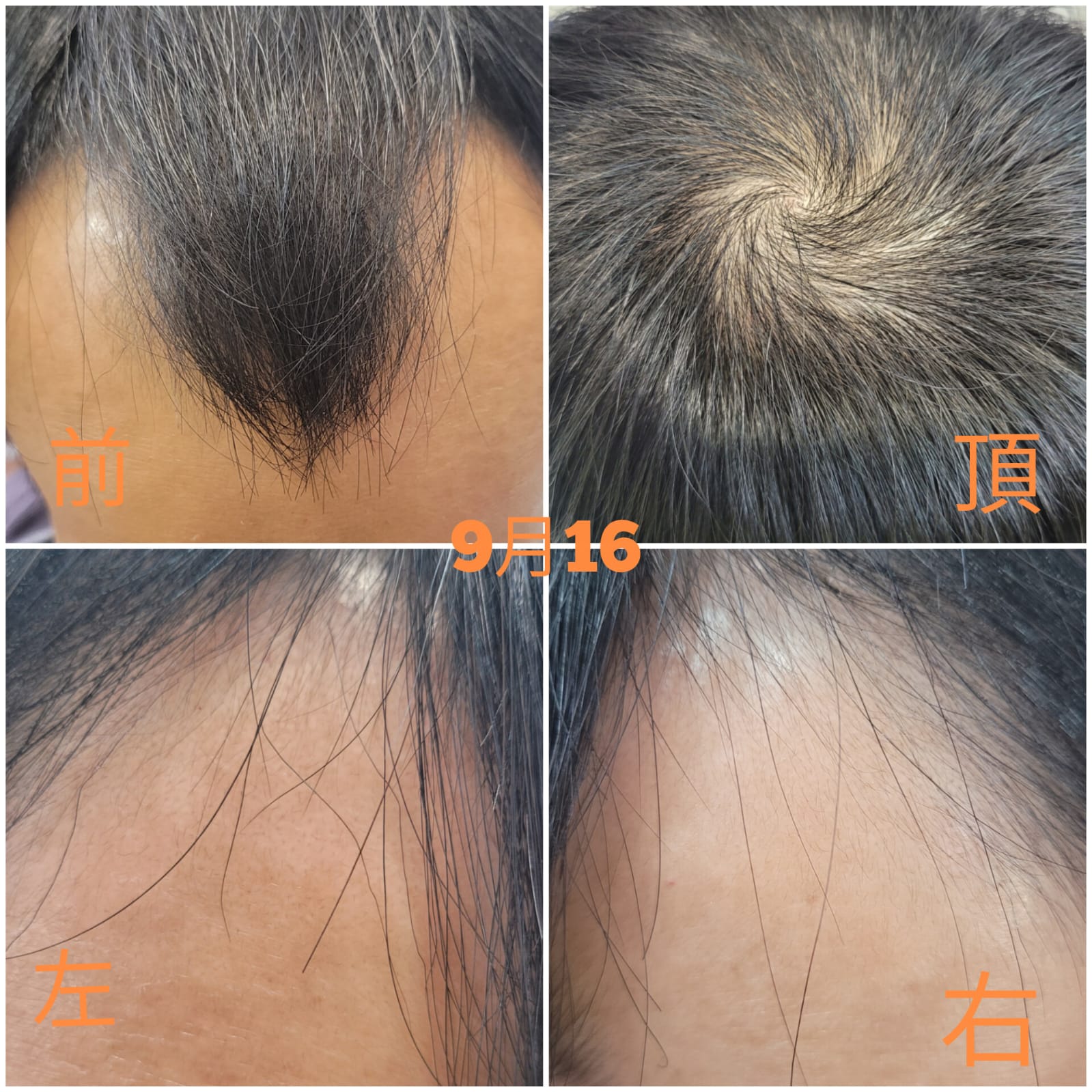 治療後：重拾濃密