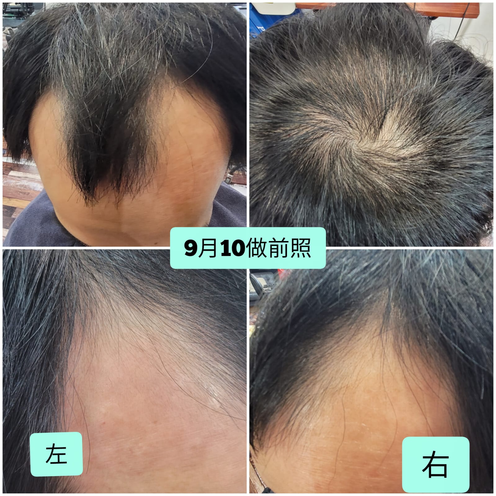 治療前：嚴重M字額