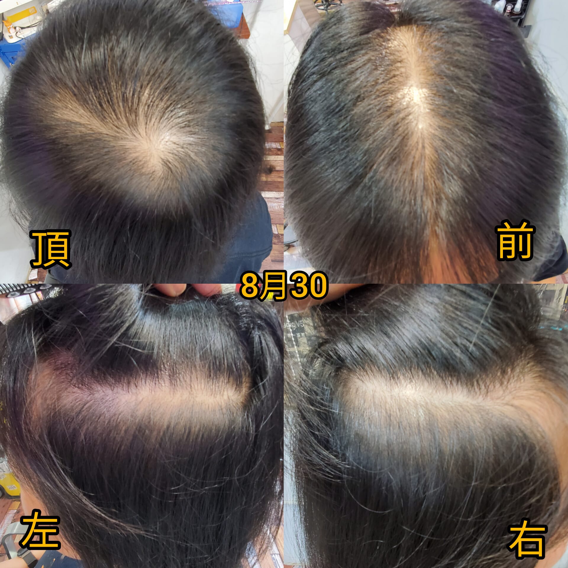 治療前：稀疏脆弱
