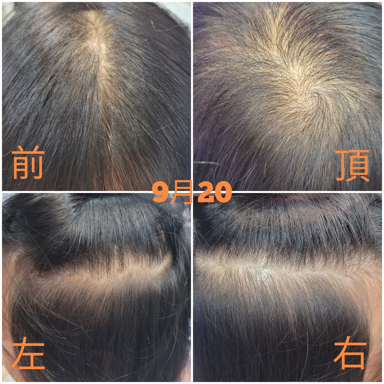 二十日對比：驚人改變